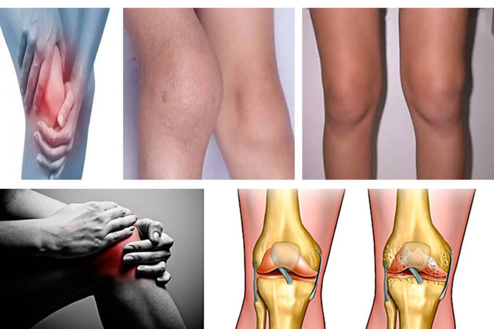 Symptoms of knee arthrosis